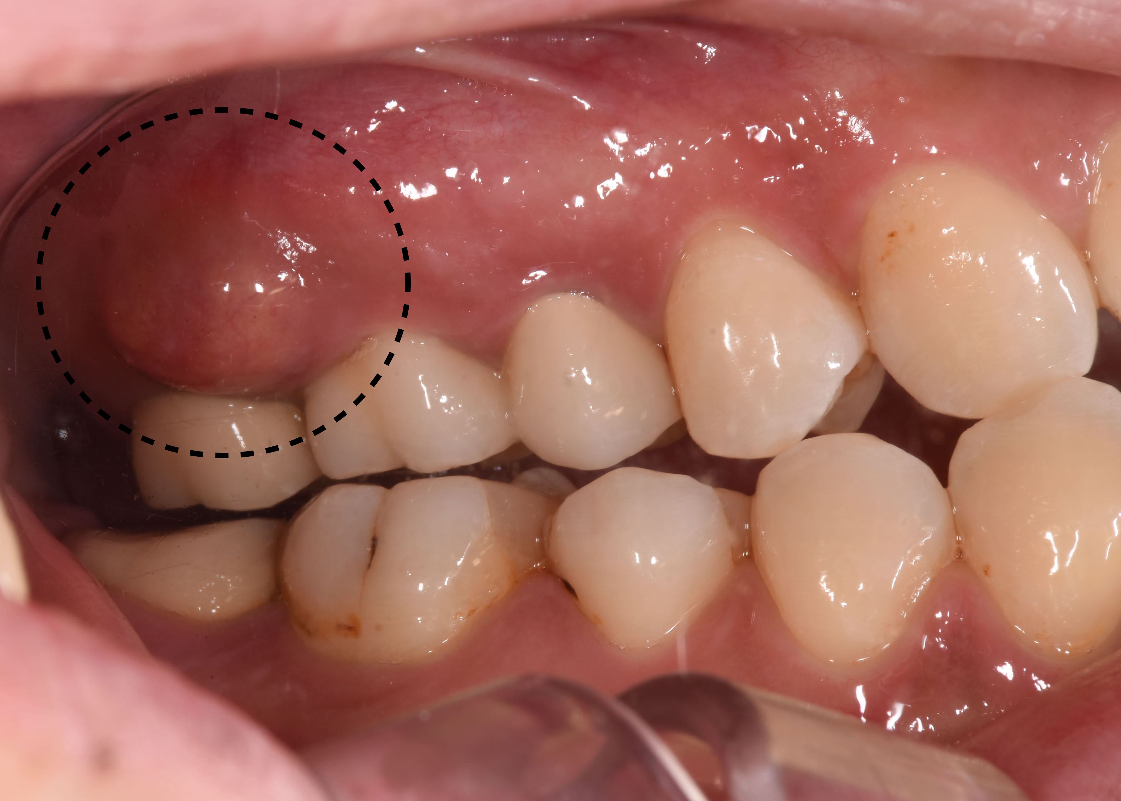 奥歯 の 歯茎 が 腫れる