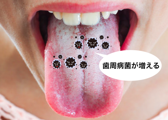 舌が白い人は必見 舌苔の原因と除去の方法を歯医者が徹底解説 Ken S Note