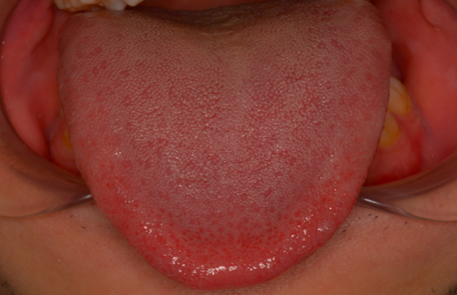 舌が白い人は必見 舌苔の原因と除去の方法を歯医者が徹底解説 Ken S Note