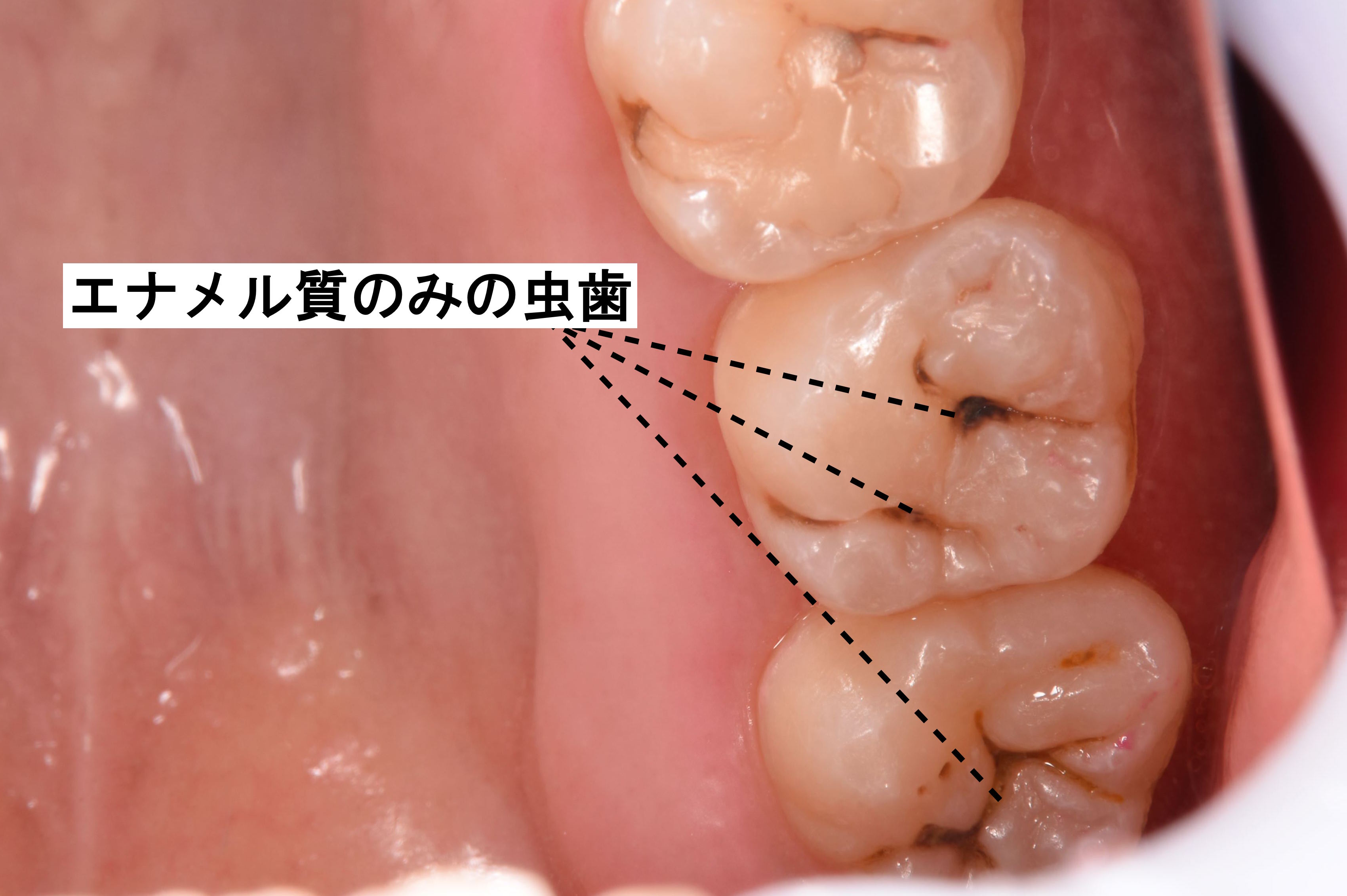 C1　エナメル質に限局した虫歯の画像
