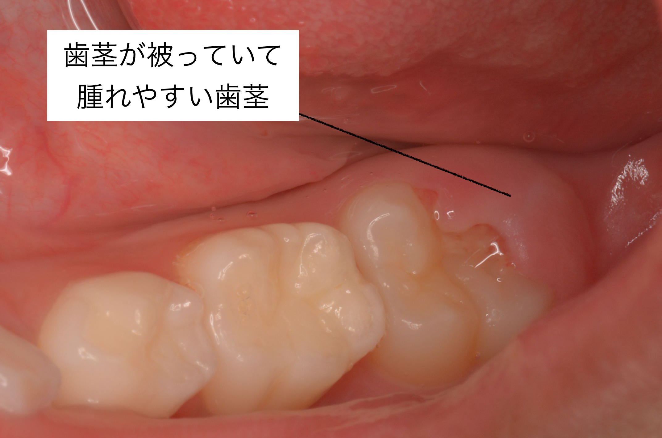 歯茎 の 化膿