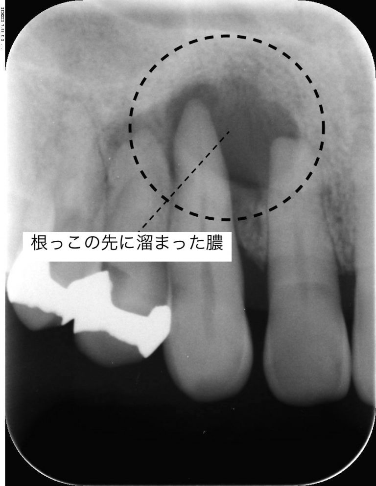 【保存版】歯茎が腫れた!原因と今すぐできる6つの応急処置 | Ken's Note