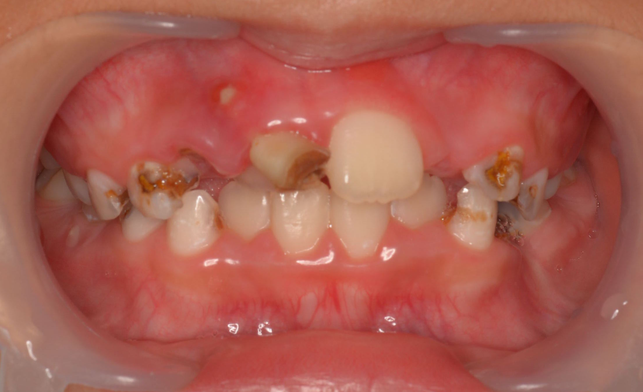 子供 乳歯 の虫歯は永久歯にも悪影響 原因と治療法まとめ Ken S Note