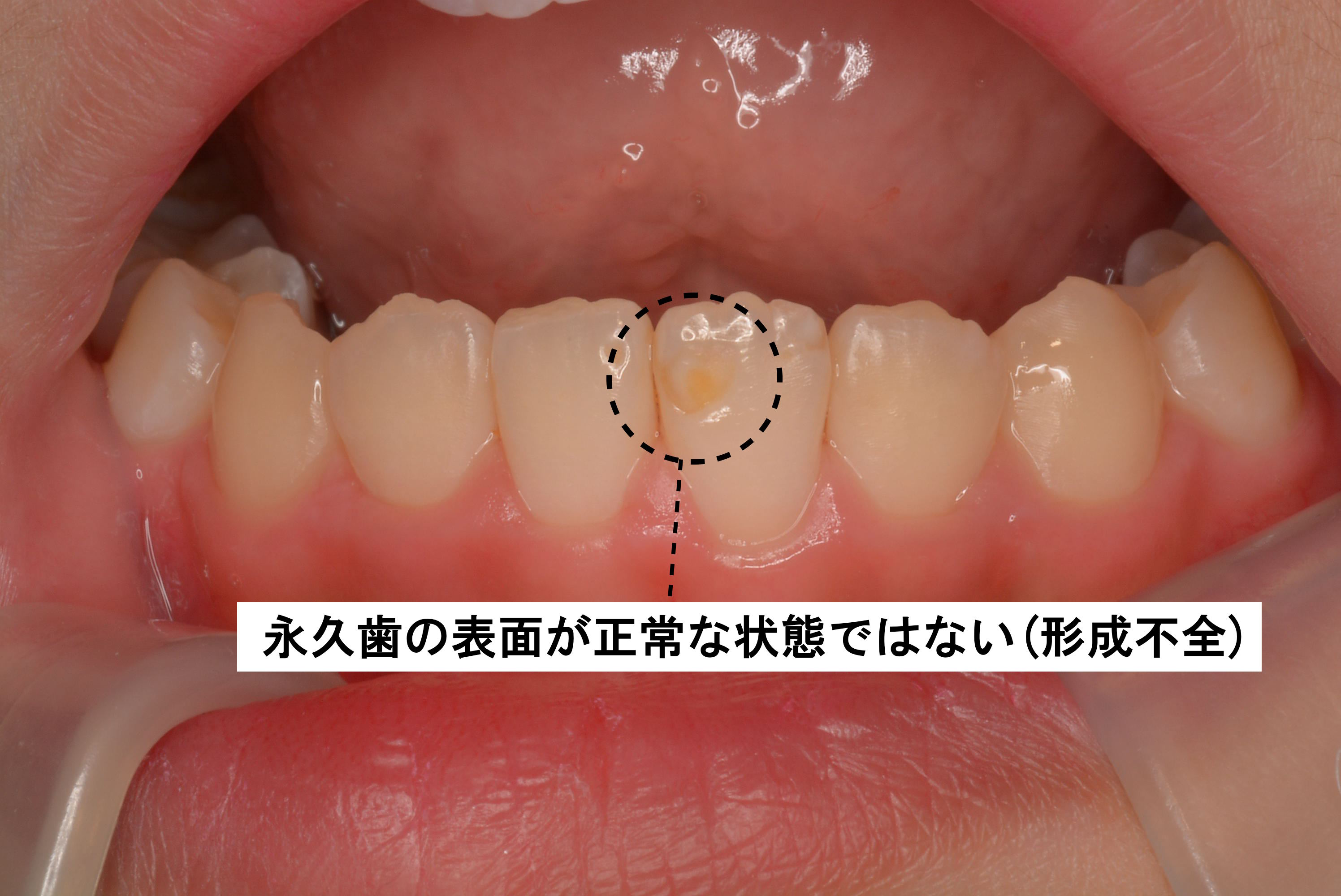 子供 乳歯 の虫歯は永久歯にも悪影響 原因と治療法まとめ Ken S Note